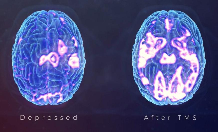 Scans of two brains side by side. The one on the left is a scan of a depressed brain and the one on the right has undergone TMS. The one which went through TMS has more colour indicating more brain activity.